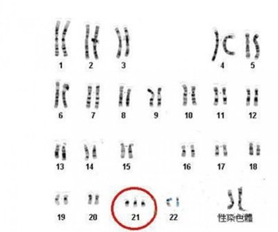 21号染色体异常会怎样,几号染色体异常最严重